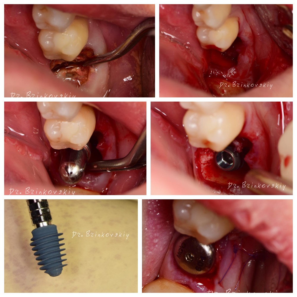 Работа доктора Instagram @dr.brinkovskiy Удаление зуба Установка имплантата AnyRidge 5,5x8,5 мм