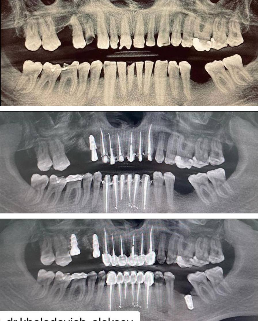 Атравматичное удаление 14,15 зубов с одномоментной имплантацией AnyRidge в области 14 зуба. Спустя 4 месяца имплантация AnyRidge в области 16 зуба. Кейс @dr.kholodovich_alekse
