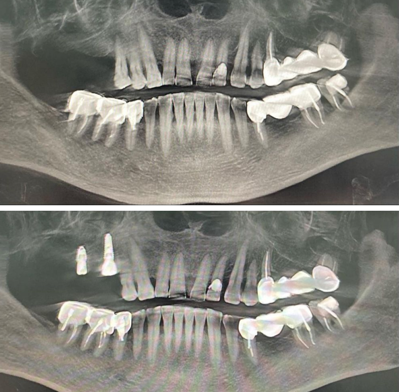 Успешная имплантация AnyRidge 15 и 16 зубов. Кейс @dr.kholodovich_aleksey
