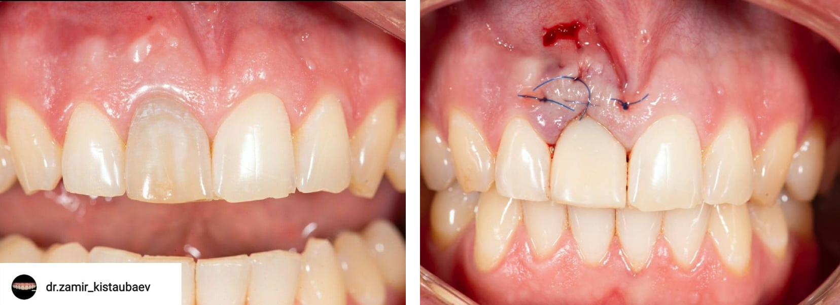 Клинический случай @dr.zamir_kistaubaev: удаление треснутого корня зуба с одномоментной имплантацией AnyRidge