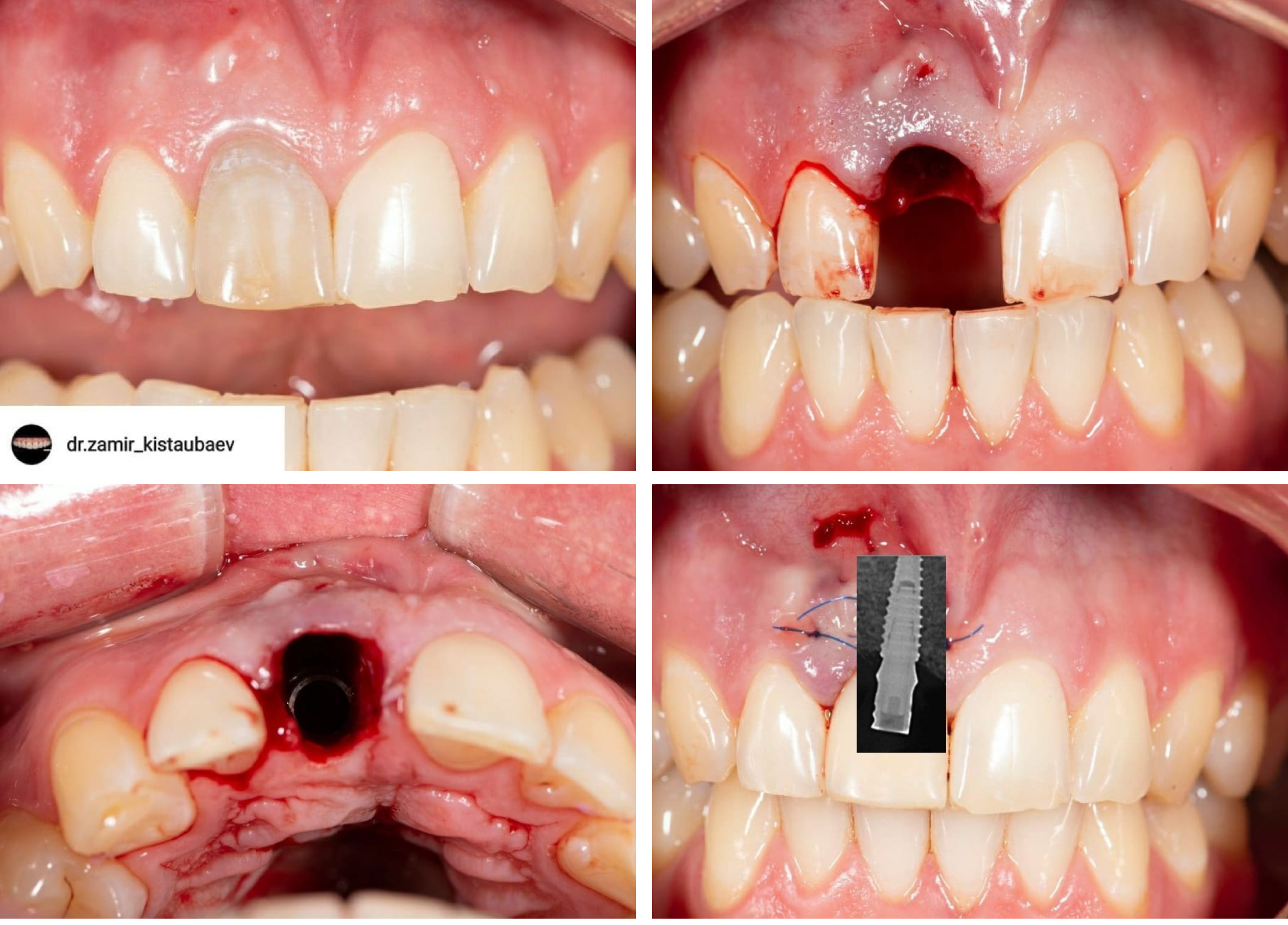 Клинический случай @dr.zamir_kistaubaev: удаление треснутого корня зуба с одномоментной имплантацией AnyRidge