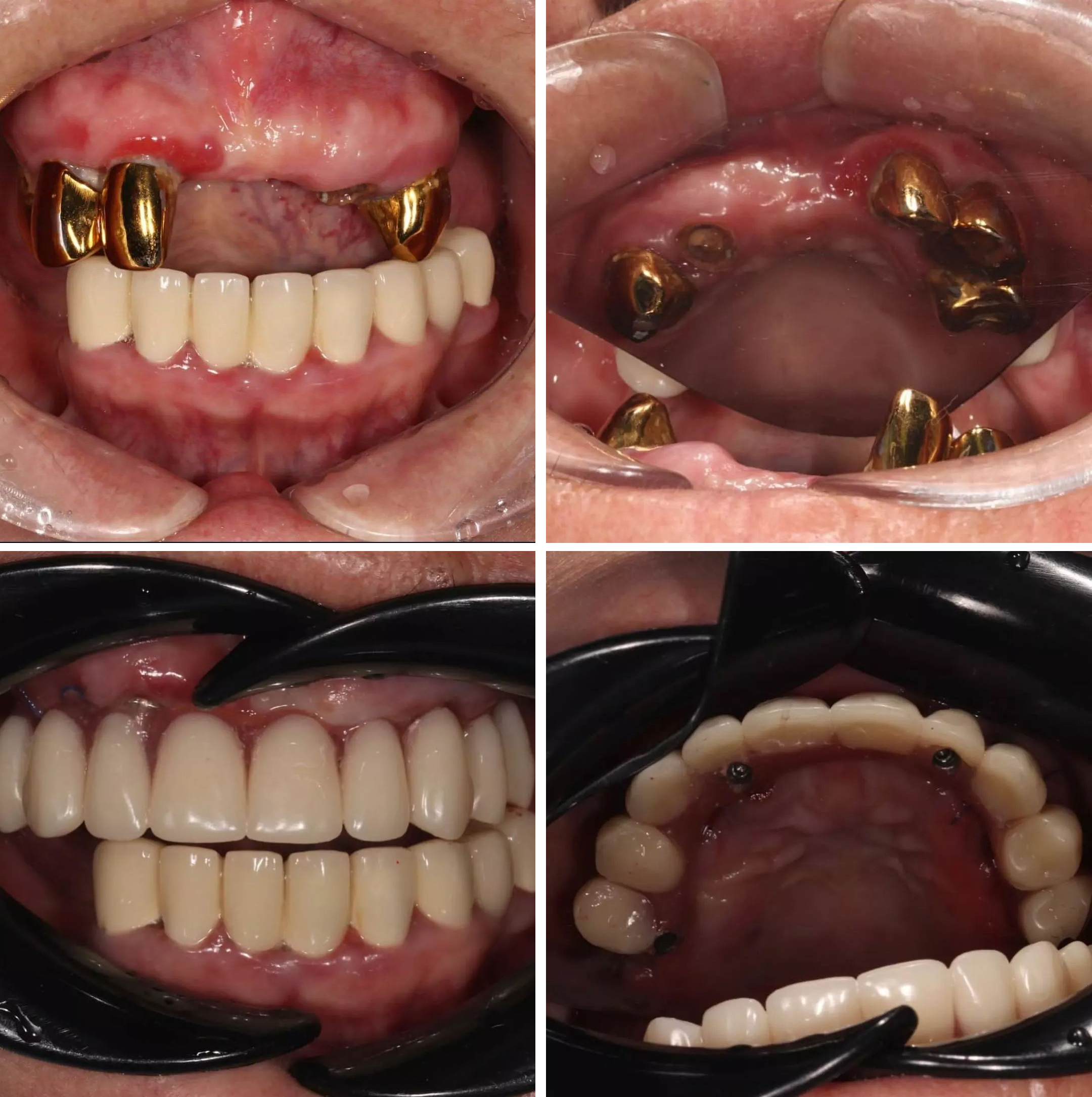 Кейс @dr_lesbekov_azat: удаление нездоровых зубов, установка 4 корейских имплантатов с мульти-юнитом AnyRigde с последующей фиксацией несъёмной временной конструкцию в тот же день
