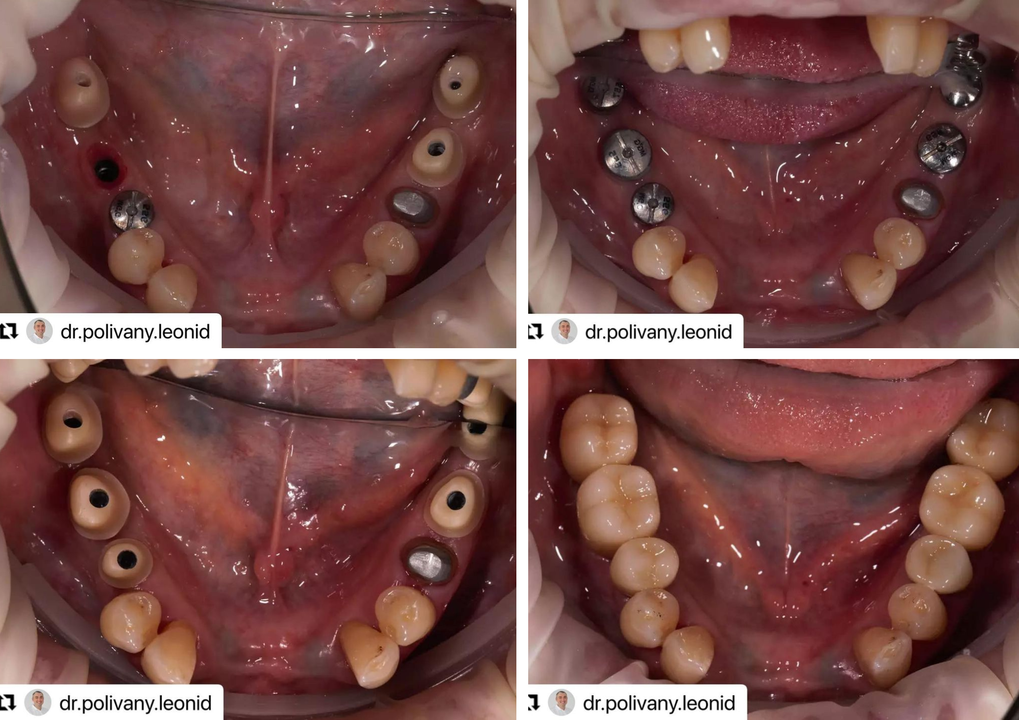 Протезирование жевательных зубов коронками из диоксид циркония на имплантах AnyRidge. Работа доктора @dr.polivany.leonid выполнена за два визита
