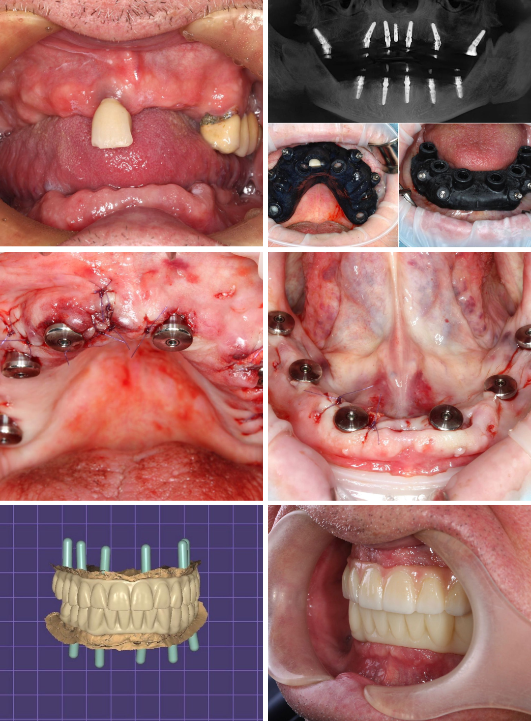 Клинический случай @Практик Дентал: удаление несостоятельных зубов и установка 12 имплантатов AnyRidge