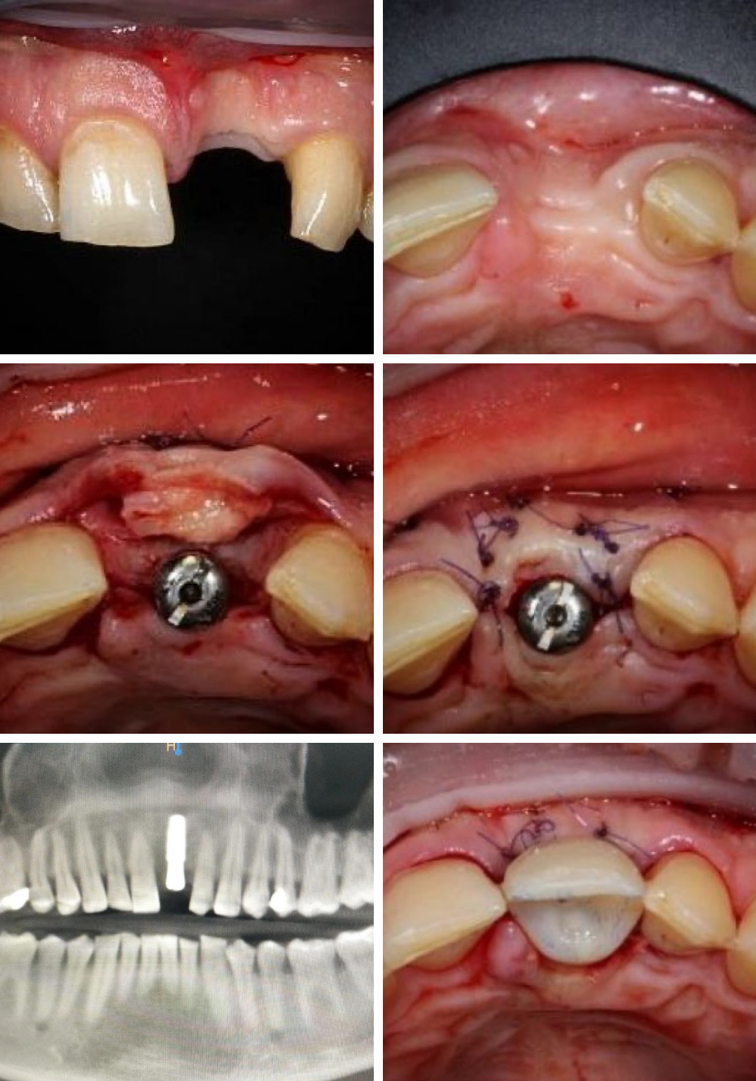 Проведена дентальная имплантация AnyRidge зуба 2.1 с пластикой десны (десневой трансплантат  получен с твердого неба верхней челюсти), а также установлена временная коронка. Кейс @zuby_pro32