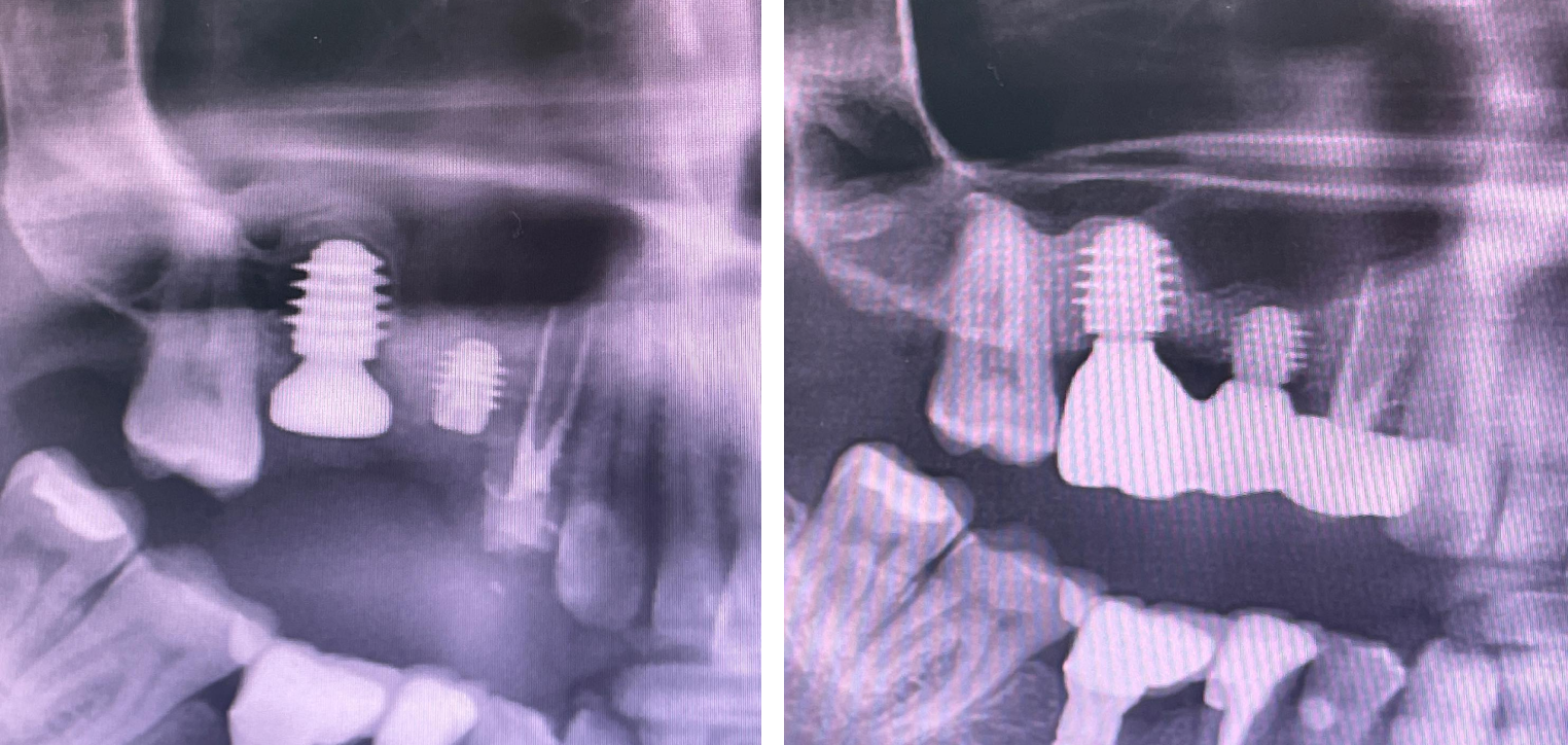 Сверхкороткий имплантат AnyRidge в области 15 зуба позволил избежать синус-лифтинга, а в области 16 зуба позволил провести одномоментную имплантацию у моляра со сросшимися корнями. Хабиев К.Н