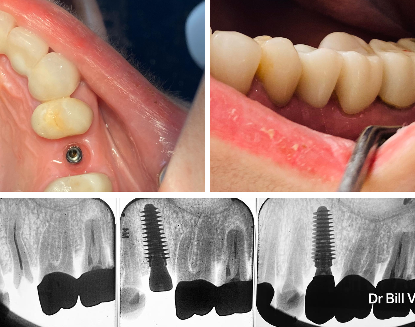 Успешная и предсказуемая имплантация AnyRidge зуба №15. Кейс @Bill Vu