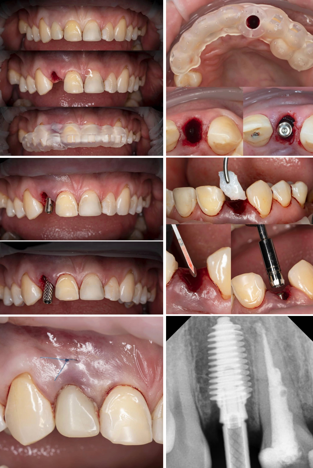 Кейс @smiledesign_spb. Удаление сломанного зуба, установка имплантата AnyRidge с помощью хирургического шаблона, десневая коррекция трансплантатом, фиксация временной коронки.