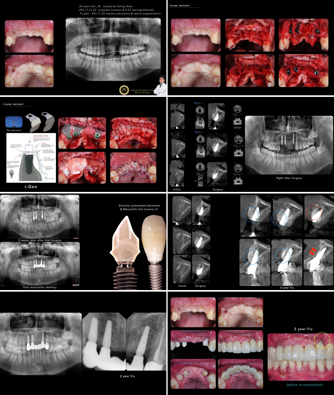 Клинический случай Seung Yeup Lee: проведена направленная костная регенерация с установкой мембраны iGen, с последующей имплантацией Anyridge зубов №12,11,22.